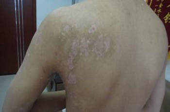 白癜風患者小心內火纏身 石家莊治療白癜風好醫院提醒