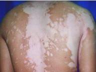 治療白癜風(fēng)其實&ldquo;so easy&rdquo;