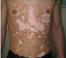 白癜風重要的治療方法