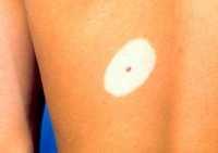 后背上的白癜風能治好嗎