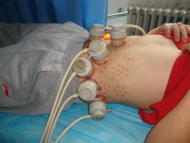 白癜風(fēng)植皮手術(shù)效果怎么樣