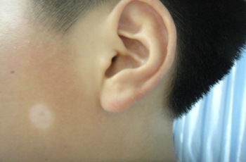 石家莊白癜風治療偏方有哪些呢