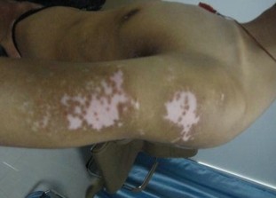 治療白癜風可以用什么技術才好