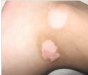 白癜風怎么治有效果