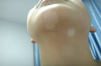 白癜風(fēng)復(fù)發(fā)后如何治療