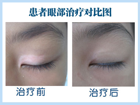 進(jìn)展期的面部白癜風(fēng)怎么治