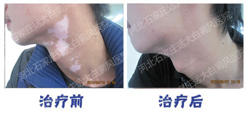 白癜風應該如何去治療見效才比較快呢