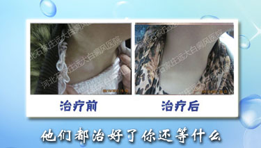 脖子白癜風用哪些方法治療好