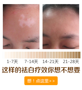 白癜風早期治療用什么方法可以治好