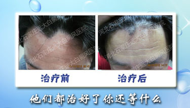 毛囊型的白癜風(fēng)治療