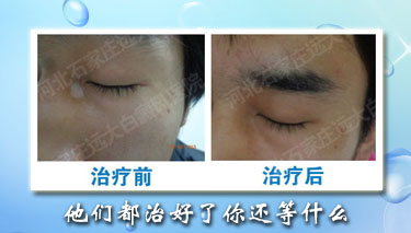 白癜風全身都有，可怎么辦