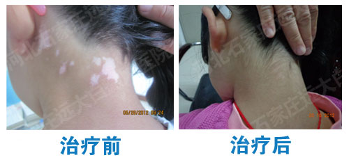 白癜風白斑發癢是不是要治好了