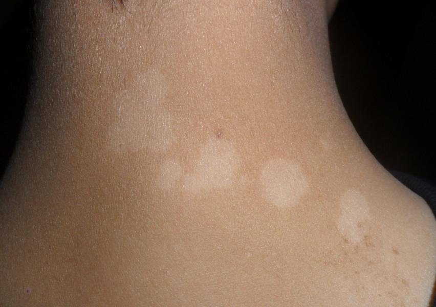 白癜風(fēng)患部有脫皮現(xiàn)象還能用藥嗎