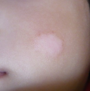 308激光照白癜風到什么時候算好