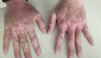 白癜風患者飲食上是有規定的