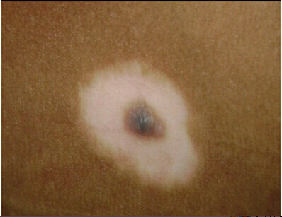 暈痣型的白癜風(fēng)需要患者治療嗎