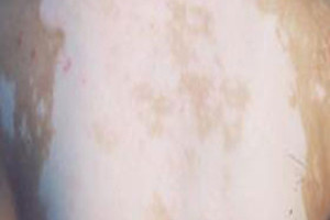 腰部長了白癜風(fēng)該怎么辦