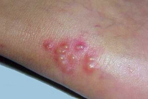 308激光照射白癜風起水泡的原因