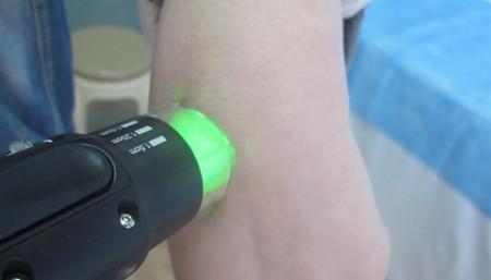 美國(guó)308激光治療白癜風(fēng)一天照幾次合適