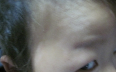 擴散的白癜風怎么治療見效快