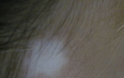 孩子白癜風(fēng)怎么治