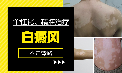 女性局限型白癜風怎么治療