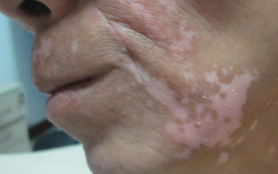  夏季怎么喝補(bǔ)銅口服液治白癜風(fēng)