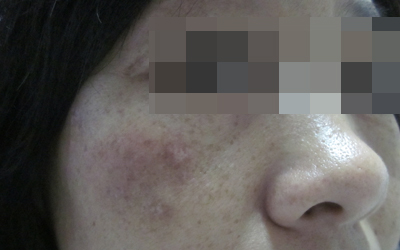 早期白癜風(fēng)吃什么藥好