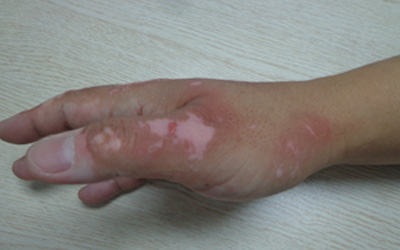 手部患上白癜風要如何是好