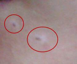 暈痣型白斑會不會發展成白癜風怎么治