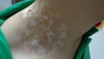 脖子上的白癜風又變多了