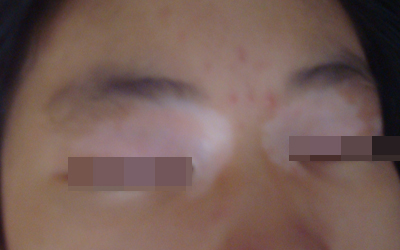 白斑已經很白了怎么辦