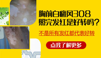 白癜風照光變紅是好轉嗎