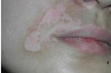 308治療嘴唇上的白癜風有用嗎