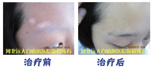 早期白癜風的癥狀