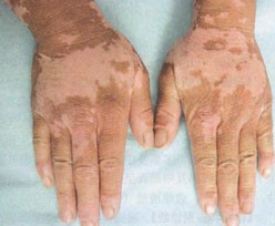 光療對手指白癜風是否有效果