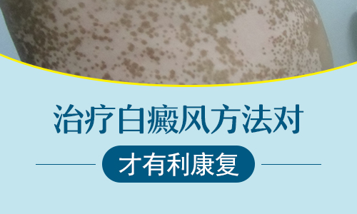 燙傷過后變白一定是白癜風(fēng)嗎