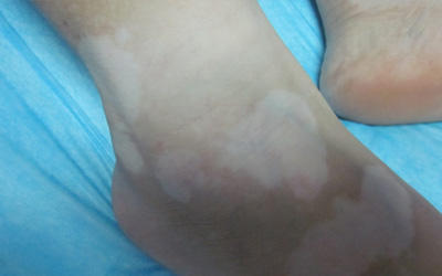 腳上白癜風不擴散不治療是否可以