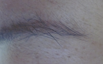 白斑在眼眉邊緣有兩個月了怎么辦