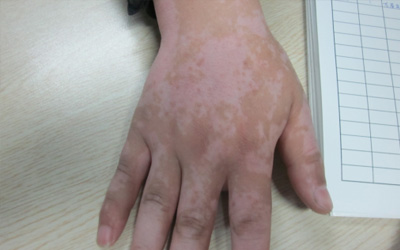 激光照手上白癜風(fēng)不容易有效果