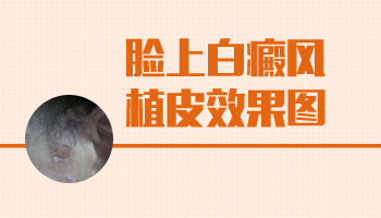 面部白癜風(fēng)黑色素移植后皮膚發(fā)黑是怎么回事