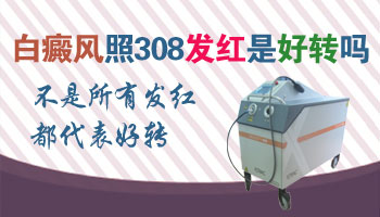 白癜風做完308紅了能涂卡泊嗎