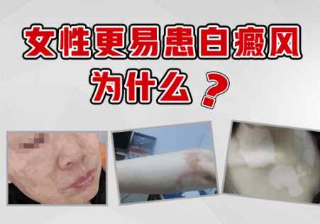 4個月孩子胳膊發現白斑不吃藥能治療好嗎，用什么儀器