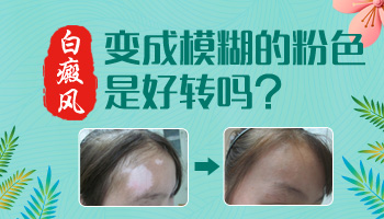 兒童額頭巴掌大白斑照完308紅多久是正常的