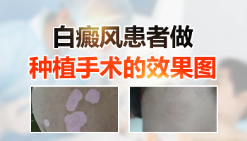 4個月孩子胳膊發現白斑該怎么用藥恢復的快
