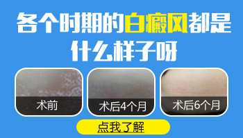 頭部白斑有雞蛋大用308nm準分子激光照多少錢