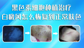 1歲孩子手臂黃豆大白斑伍德燈檢查為陽性是白癜風(fēng)嗎