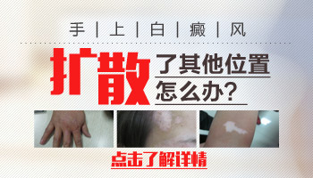 4個月孩子后背黃豆大白斑照伍德燈亮白色是不是白癜風