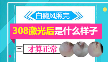 7個月孩子脖子圓形白斑照308后發黑是不是好轉了