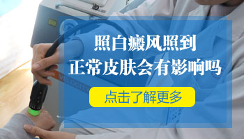 1歲孩子腳上有白斑照308激光發(fā)紅對患處好不好